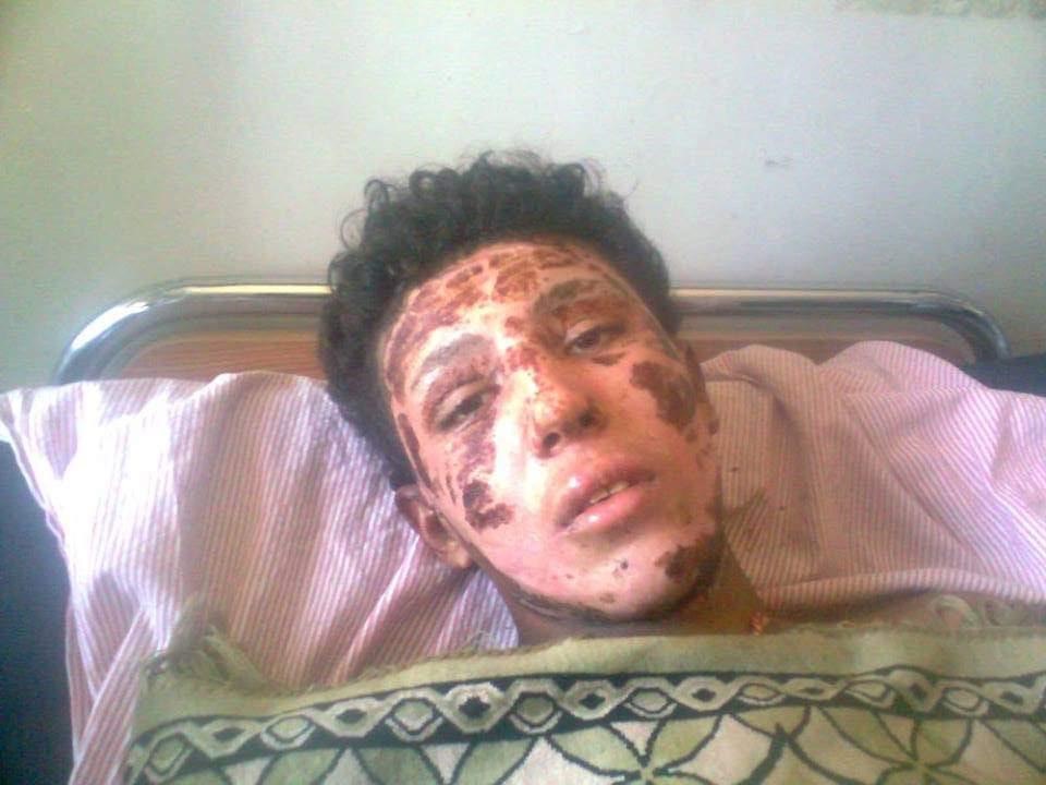 Mohammed Al Zaza lying on a hospital bed. He has severe burns on his forehead, cheeks, chin, eyelids, and nose. His expression reflects exhaustion and pain. 